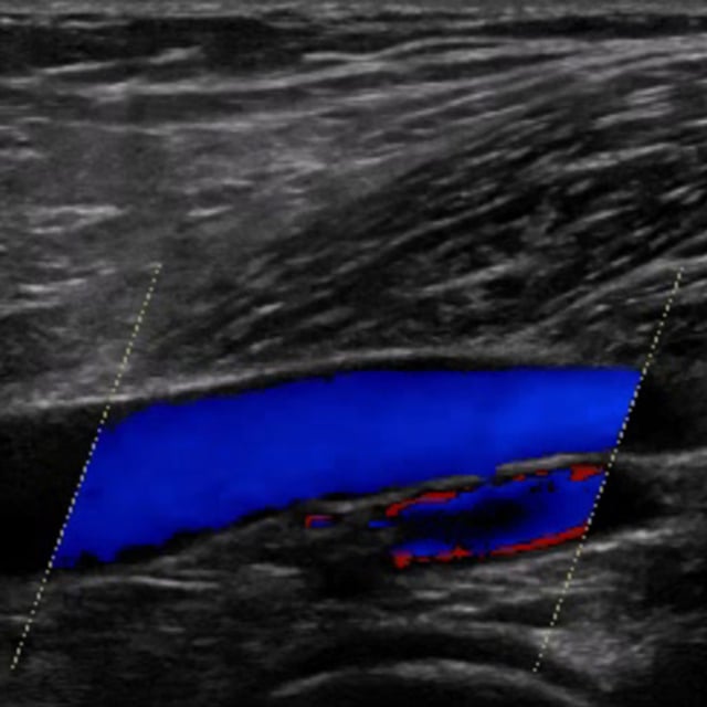 leg_venous_ultrasound__73561