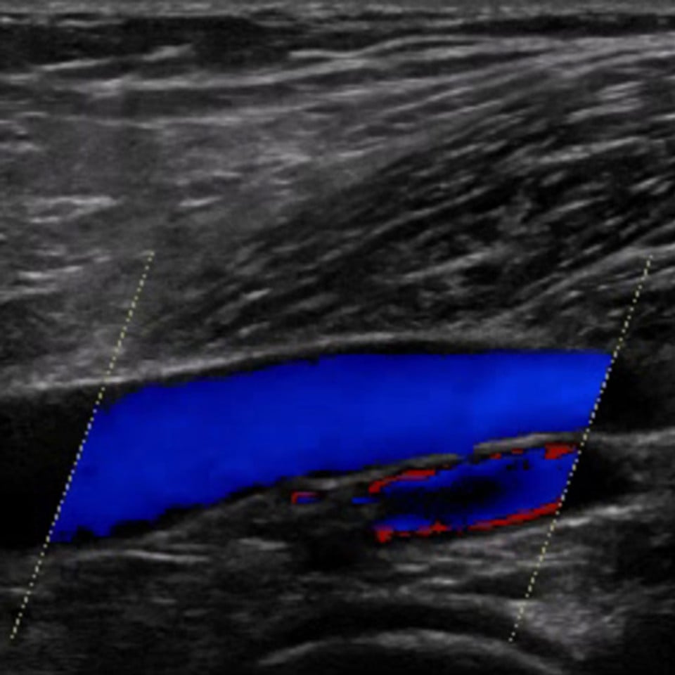 leg_venous_ultrasound__73561
