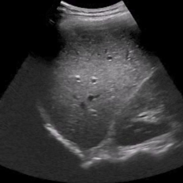 liver_ultrasound