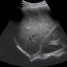 Liver Ultrasound Image from SonoSim Ultrasound Training