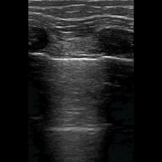 lung_ultrasound__30080
