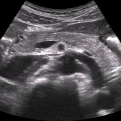 pancreas_ultrasound__30402