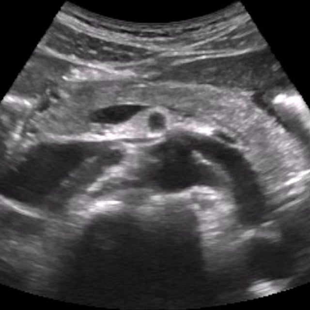 pancreas_ultrasound__30402