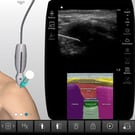 Acromioclavicular Joint Injection & Aspiration