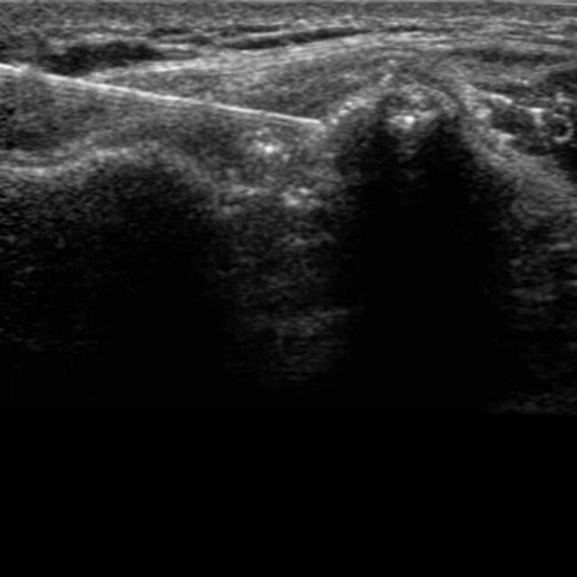 procedure_acromio_ultrasound__13450