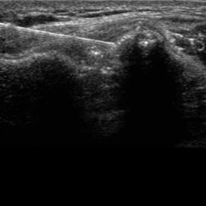 procedure_acromio_ultrasound__13450 procedure_acromio_ultrasound__13450