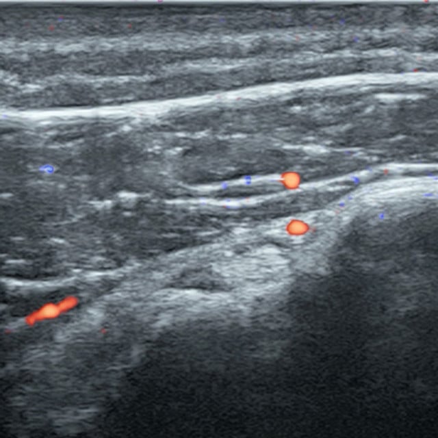procedure_biceps_ultrasound__04157