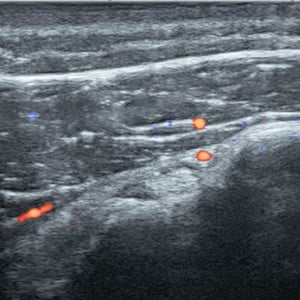 procedure_biceps_ultrasound__04157 procedure_biceps_ultrasound__04157