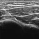 Ultrasound image from Glenohumeral Joint Injection & Aspiration training, part of SonoSim's Ultrasound-Guided Procedures series