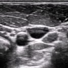 Ultrasound image of Internal Jugular Vein Cannulation, part of SonoSim's Ultrasound-Guided Procedures training series.