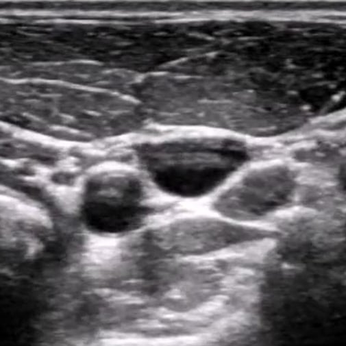 procedure_ij_ultrasound
