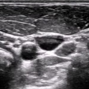 procedure_ij_ultrasound procedure_ij_ultrasound