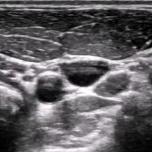 procedure_ij_ultrasound__58698 procedure_ij_ultrasound__58698