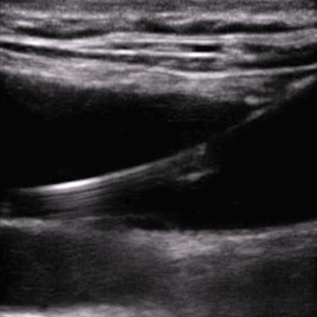 procedure_intro_ultrasound__85464
