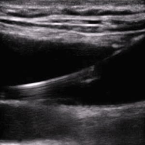 procedure_intro_ultrasound__85464 procedure_intro_ultrasound__85464