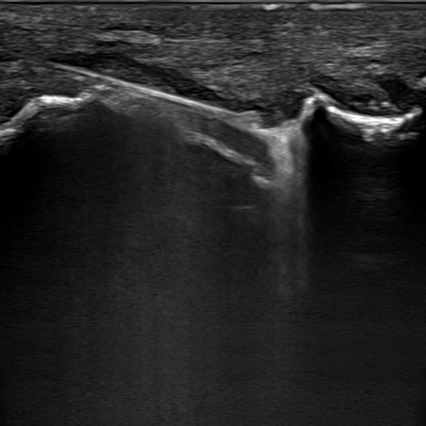 procedure_metatarsophalangeal_ultrasound__66873.1652906584.386.513