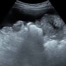 Ultrasound image from Ultrasound-Guided Paracentesis Procedure Training, part of SonoSim's Ultrasound-Guided Procedures series.
