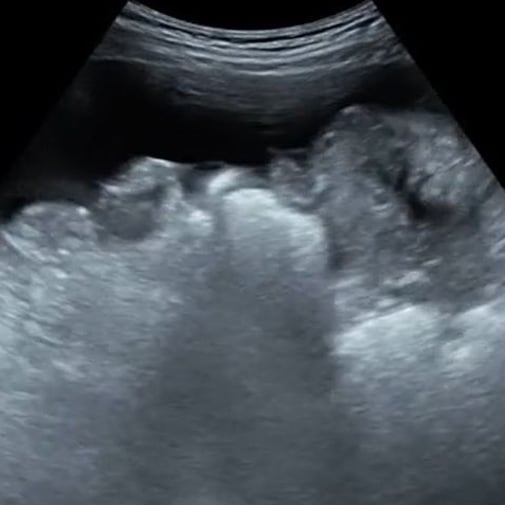 procedure_paracentesis_ultrasound