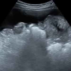 procedure_paracentesis_ultrasound procedure_paracentesis_ultrasound
