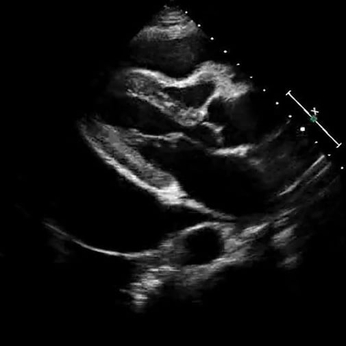 procedure_pericardiocentesis_ultrasound