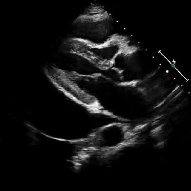 procedure_pericardiocentesis_ultrasound__56779