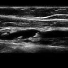 Ultrasound image of Peripheral Venous Access, part of SonoSim's Ultrasound-Guided Procedures training series.