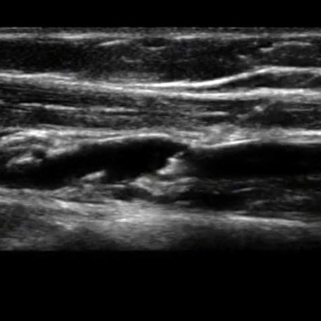 procedure_peripheral_ultrasound__34317-1