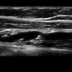 procedure_peripheral_ultrasound__34317-1 procedure_peripheral_ultrasound__34317-1