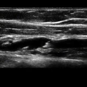 procedure_peripheral_ultrasound__34317 procedure_peripheral_ultrasound__34317