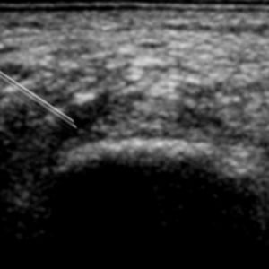 procedure_plantar_fasciitis_ultrasound__14369 procedure_plantar_fasciitis_ultrasound__14369