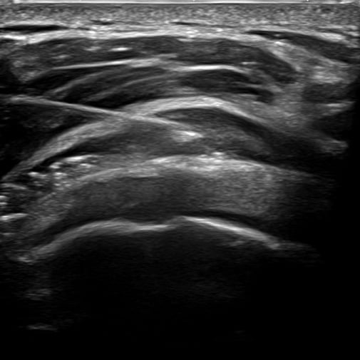 procedure_subacromio_ultrasound