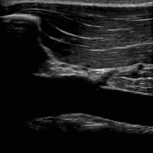 procedure_subclavian_ultrasound