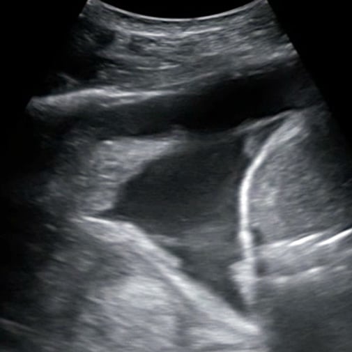 procedure_thoracentesis_ultrasound