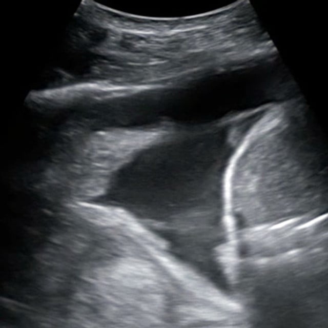 procedure_thoracentesis_ultrasound__02141