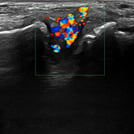 Ultrasound image from Tibiotalar Joint Injection & Aspiration training, part of SonoSim's Ultrasound-Guided Procedures series.