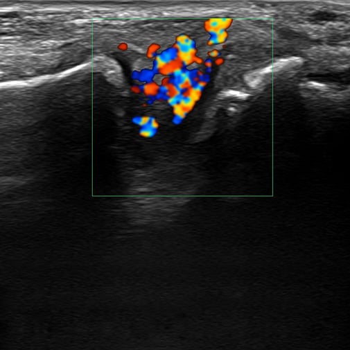 procedure_tibiotalar_ultrasound