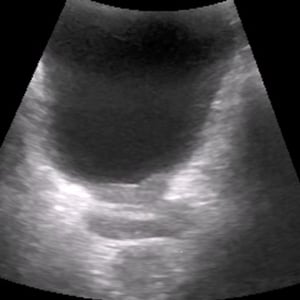 prostate_ultrasound__85054