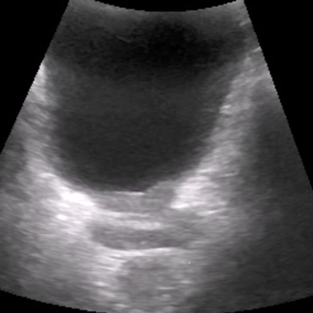 prostate_ultrasound__85054