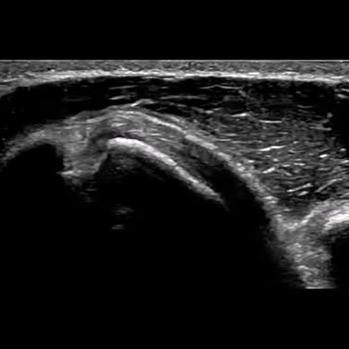 shoulder_ultrasound