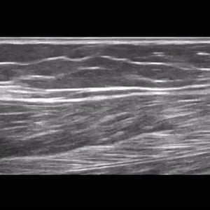 softtissue_ultrasound__00888
