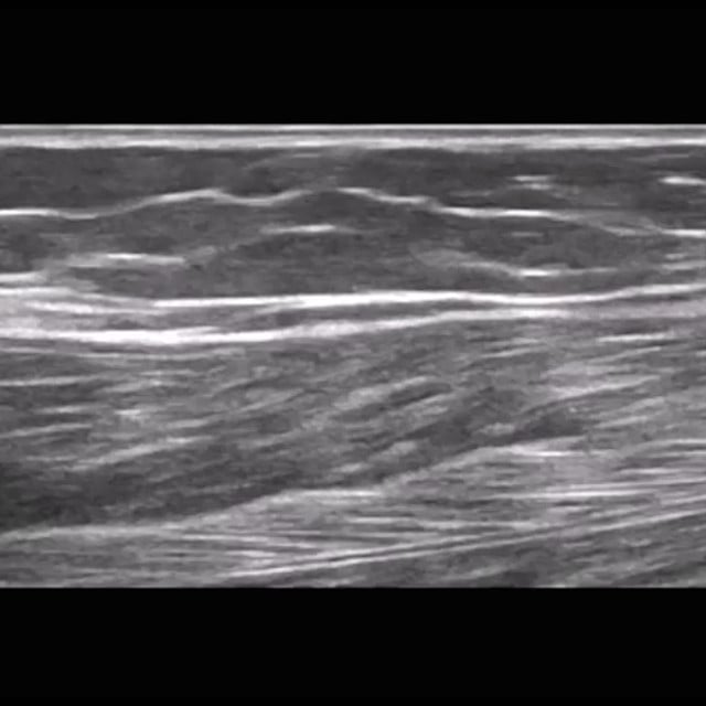softtissue_ultrasound__00888