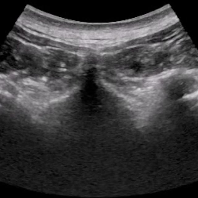 spine_ultrasound__72121