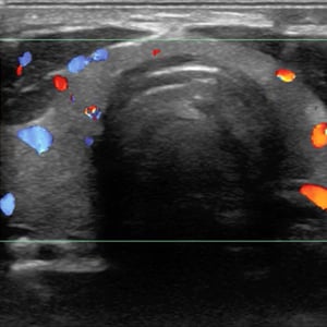thyroid_ultrasound__47364 thyroid_ultrasound__47364