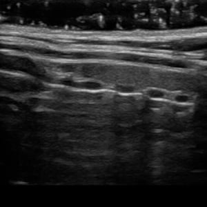upper_airway_ultrasound__67483 upper_airway_ultrasound__67483