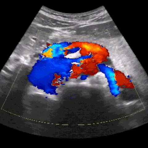 A color doppler ultrasound scan of the abdomen, a key application for point-of-care ultrasound learners
