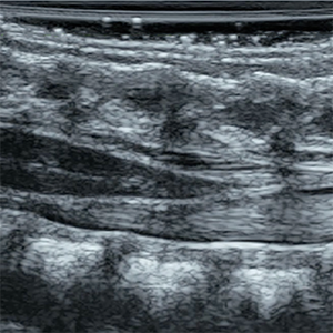 Infant Lumbar Puncture Ultrasound Training - SonoSim Ultrasound Training Infant Lumbar Puncture Ultrasound Training - SonoSim Ultrasound Training