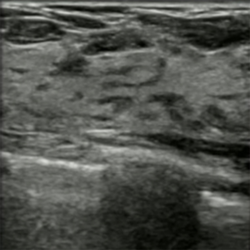 Introduction to Breast Ultrasound