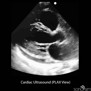 Cardiac-Ultrasound-(PLAX-View)-300x300