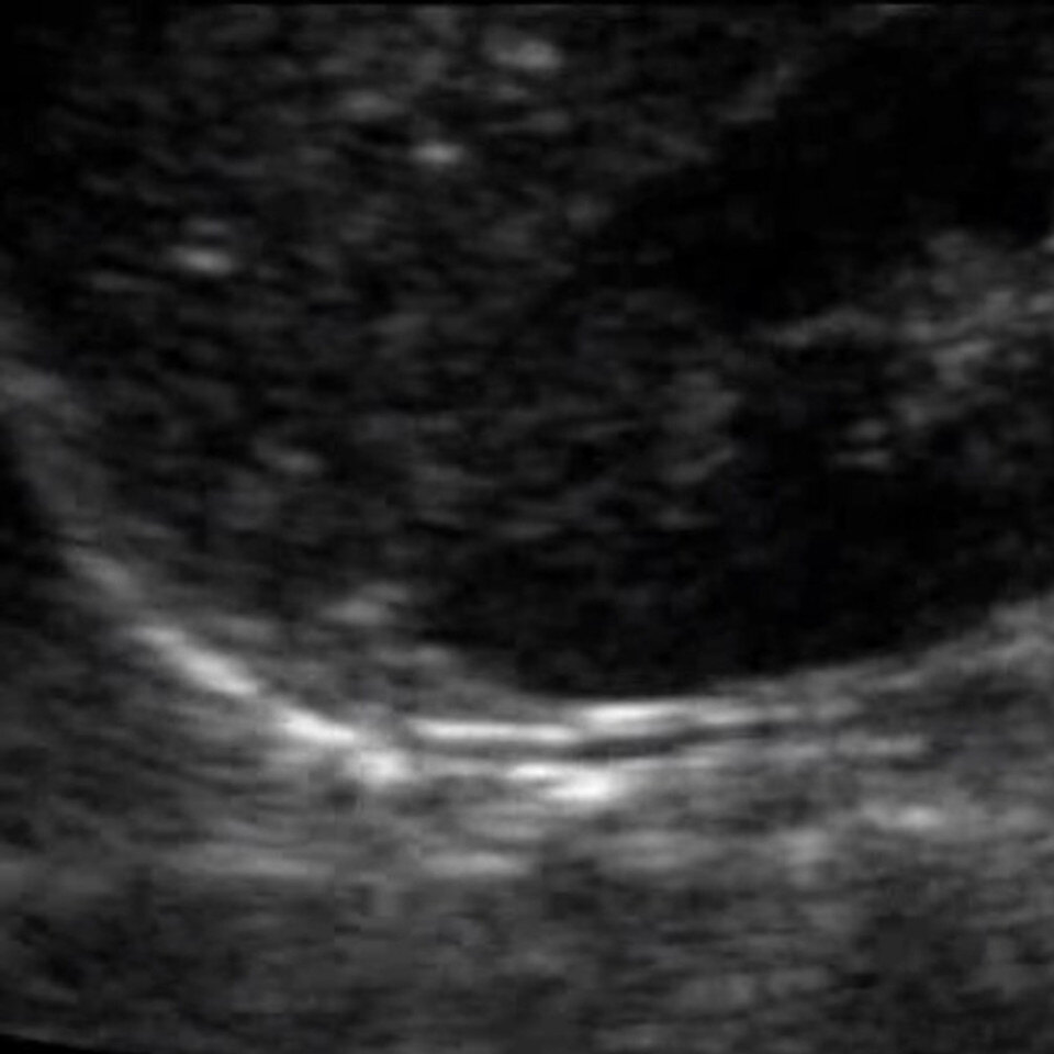 Adrenal Glands