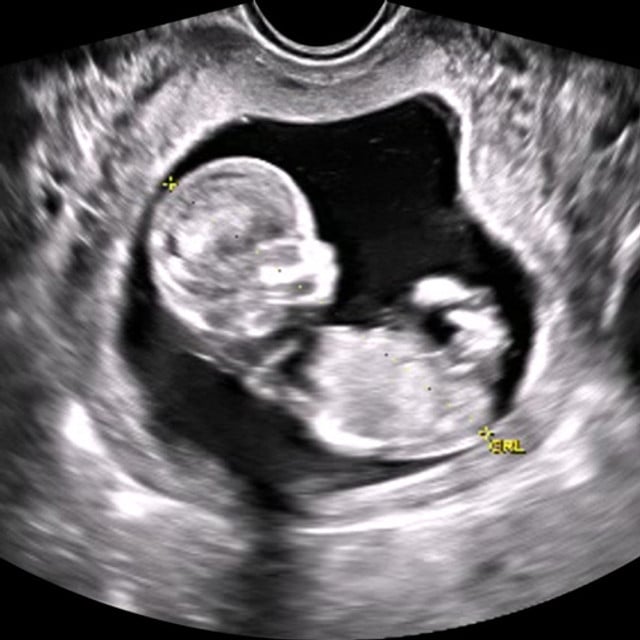 Advanced first trimester ultrasound